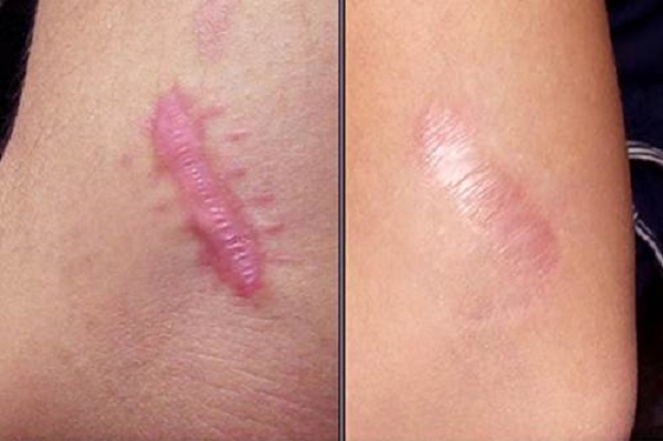 Bí quyết làm kem trị sẹo tại nhà cực kỳ dễ dàng