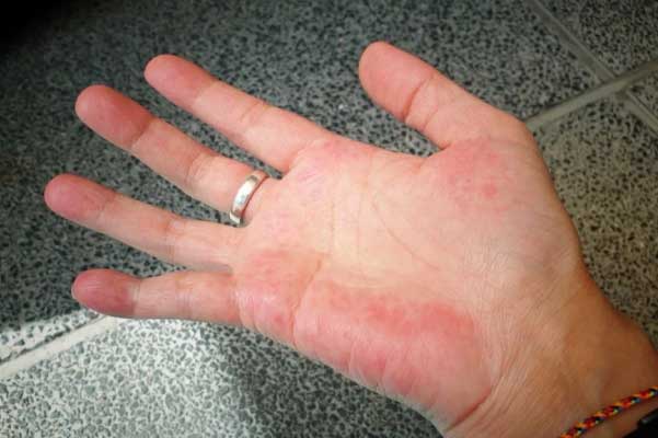 5 bất thường trên bàn tay cảnh báo bệnh gan chuyển nặng, ít ai để ý cái đầu tiên