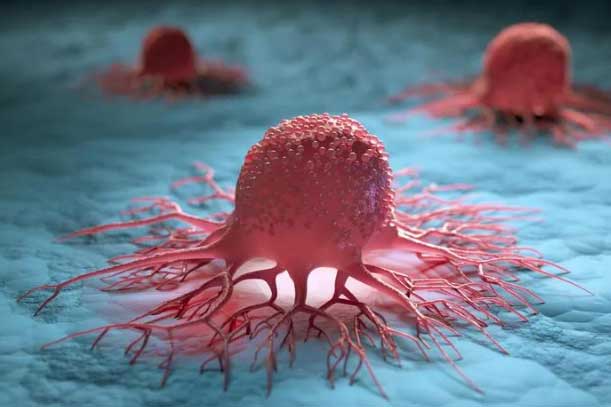 Tại sao người ta bị ung thư? Từ ung thư đến khỏe mạnh thực ra chỉ có 4 bước này