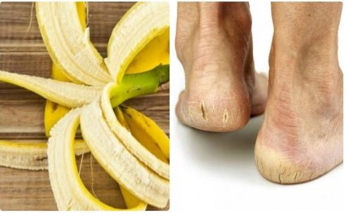 Vỏ chuối ăn xong đừng vội ném vào thùng rác: Sáng ra cứ lấy chà vào bàn chân sẽ thấy ngay điều kì diệu