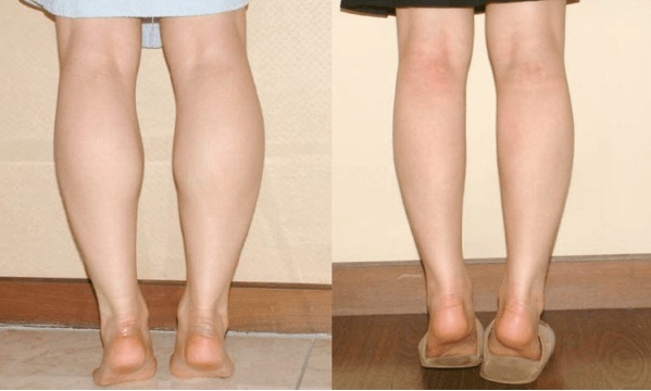 Phương pháp thu nhỏ bắp chân đơn giản, dễ thực hiện