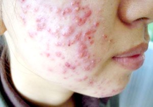 ‘Khóc thét’ vì mặt đầy mụn do dùng kem chống nắng kiểu này