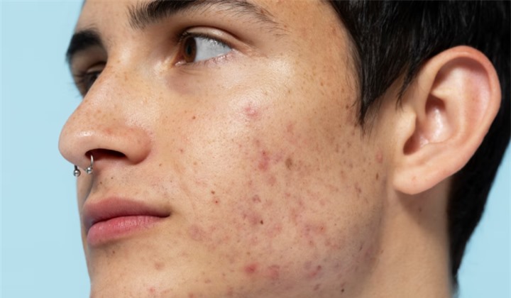 Bị mụn trứng cá, ăn gì để nhanh khỏi? - 1