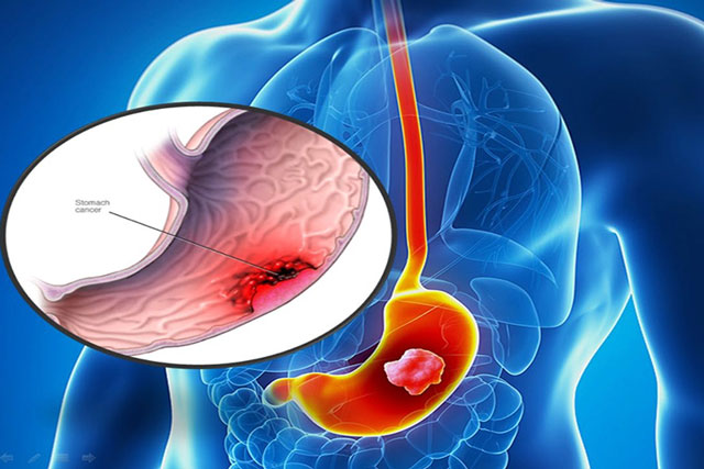 Dấu hiệu ung thư dạ dày giai đoạn đầu, cần đi khám ngay 