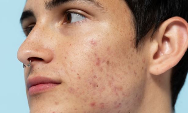 Bị mụn trứng cá, ăn gì để nhanh khỏi?