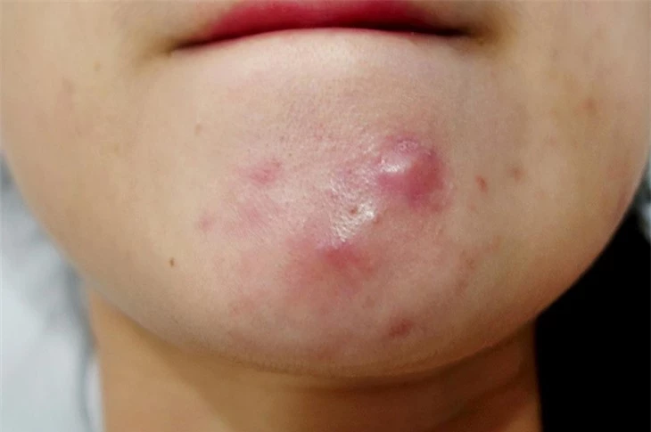 Mụn bọc và tất cả những điều bạn cần biết