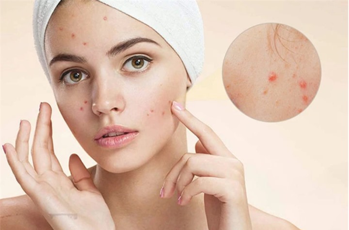 Điều trị mụn trứng cá hiệu quả nhất, không để lại di chứng trên da - 1