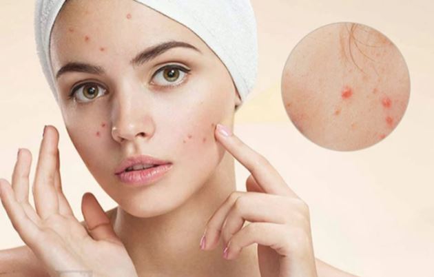 Điều trị mụn trứng cá hiệu quả nhất, không để lại di chứng trên da