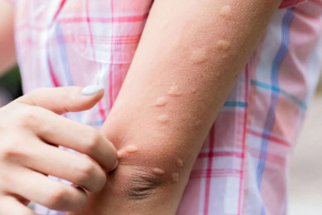 Bị muỗi đốt ngứa ngáy, khó chịu, chỉ bạn mẹo nhỏ giúp giảm ngứa ngay lập tức