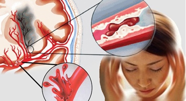 Những dấu hiệu cảnh báo mạch máu bị tắc nghẽn