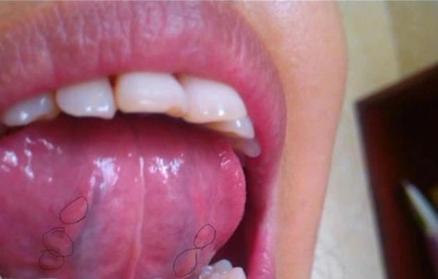 Lưỡi là "thước đo" sức khỏe, thấy 4 dấu hiệu cảnh báo này thì đừng có chủ quan