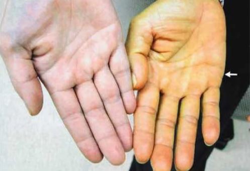 5 vị trí trên cơ thể bị đau cảnh báo bệnh gan đã đi vào giai đoạn nặng, ai không có thật đáng mừng