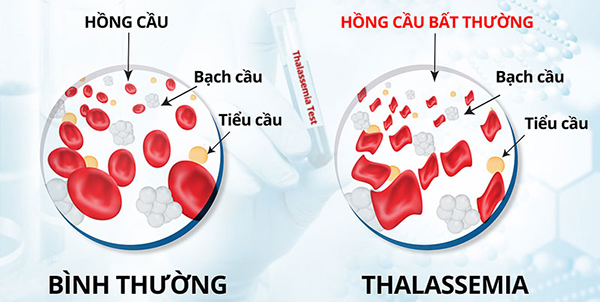 Hậu quả nặng nề của bệnh tan máu bẩm sinh và cách phòng tránh
