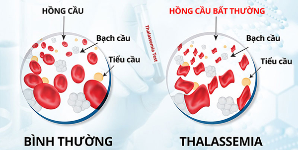 Mô tả hồng cầu bất thường khi mắc bệnh thalassemia