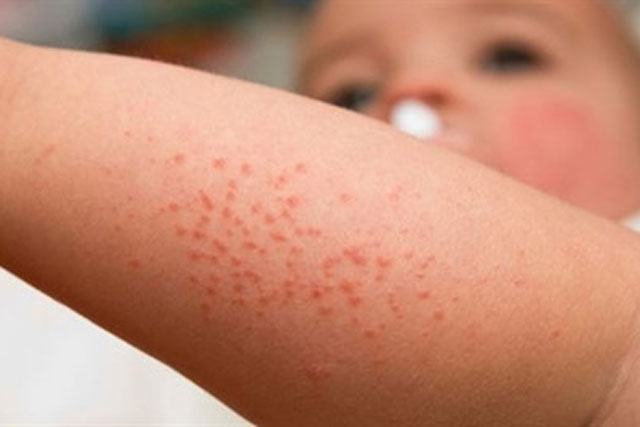 Thời tiết nắng nóng, nhiều trẻ bị rôm sảy: Bác sĩ chỉ cách phòng tránh