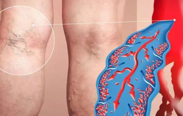 4 dấu hiệu cảnh báo cục máu đông trong cơ thể