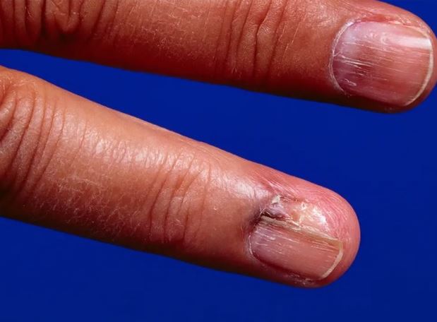 5 dấu hiệu khó nhận biết của ung thư da và lời kêu gọi của chuyên gia da liễu