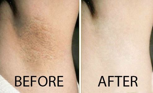 Mẹo trị thâm nách trong mùa hè giúp chị em tự tin diện váy ngắn