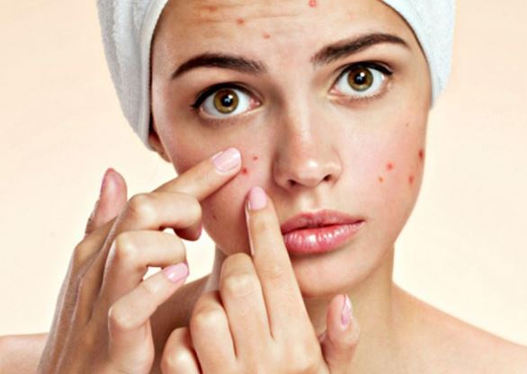 Mẹo trị mụn cấp tốc và hiệu quả, ai cũng có thể làm được