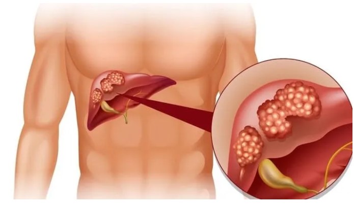 4 vùng trên cơ thể bỗng dưng đau nhói cảnh báo bệnh gan đã đi vào giai đoạn nặng