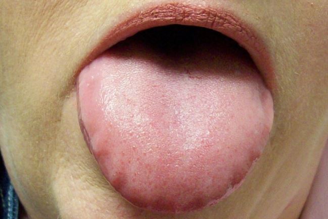 5 dấu hiệu ở lưỡi cảnh báo bệnh ung thư