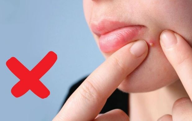 3 biến chứng đáng sợ khi nặn mụn không đúng cách