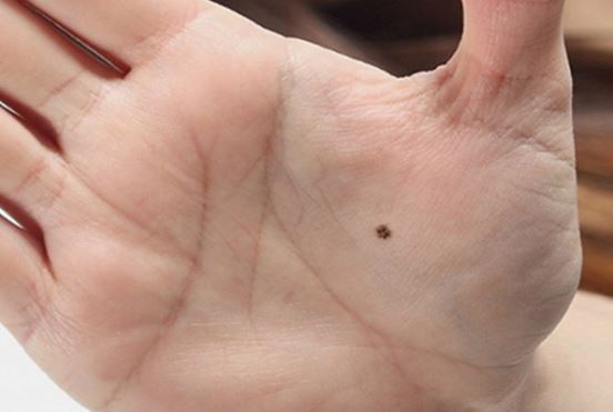 5 nốt ruồi vượng phúc, vượng tài, ai có 1 cũng đủ để sống cả đời sung túc