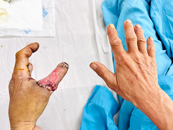 “Cái hóa” thành công cho bệnh nhân đứt lìa ngón tay