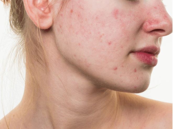 Ghi sổ một vài công thức giúp giải quyết tình trạng da vừa khô vừa bị mụn