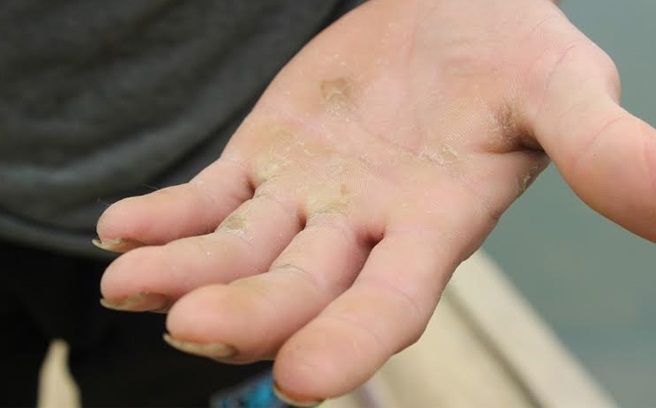 Bí quyết làm mờ vết chai tay, chai chân giúp da mềm mại ngay tức khắc