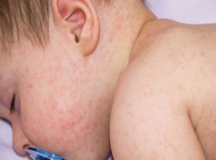 Dị ứng thời tiết ở trẻ em: Chăm sóc trẻ thế nào là đúng cách?