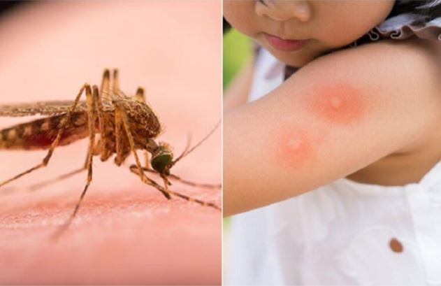 Mẹo hay giúp giảm ngứa khi bị muỗi đốt