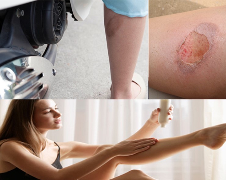 Nếu bị bỏng bô xe máy, chị em phải biết mẹo này để không bị sẹo