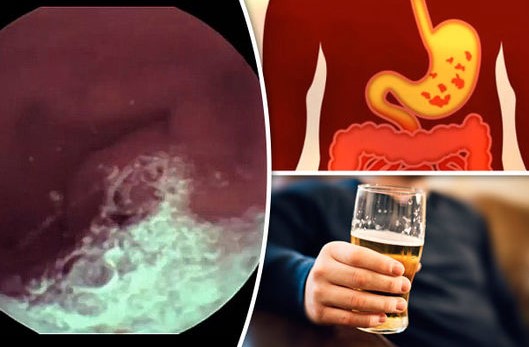 Cảnh báo sai lầm trong điều trị viêm loét dạ dày - nhiễm khuẩn HP