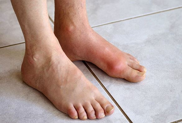 Vì sao nam giới lại mắc bệnh gout nhiều hơn nữ giới?