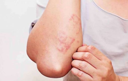 5 dấu hiệu cảnh báo bạn nhiễm giun sán