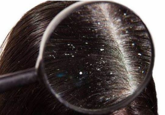 Trị gàu hiệu quả nhờ kết hợp giấm táo với nguyên liệu này