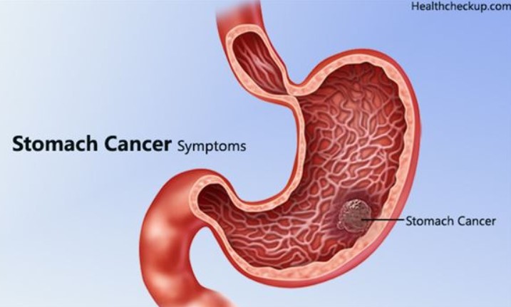 7 dấu hiệu ung thư dạ dày giai đoạn đầu