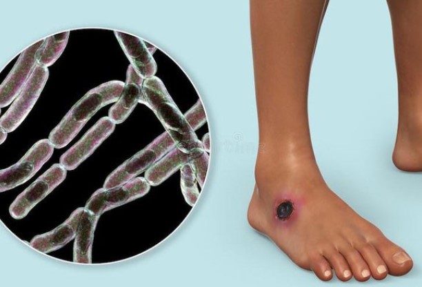 Bệnh than là gì? Triệu chứng nguyên nhân và cách điều trị bệnh than