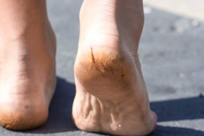 Dấu hiệu ở bàn chân chứng tỏ bạn đang có đường huyết quá cao