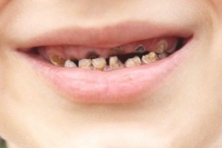 Tại sao răng sữa của bé bị mủn và 3 phương pháp khắc phục