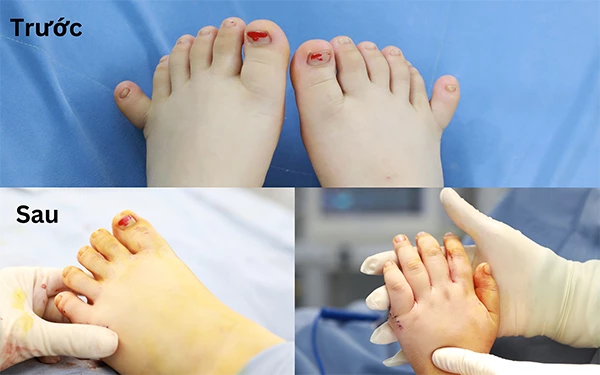 Bàn tày, bàn chân của cháu T.L trước và sau khi phẫu thuật.