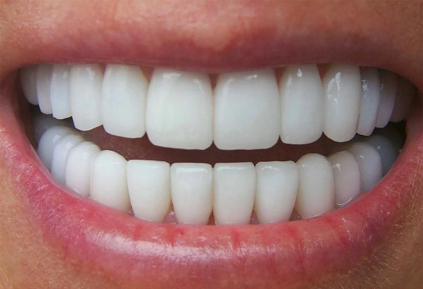 Cách xử lý tình trạng hôi miệng sau khi làm răng sứ