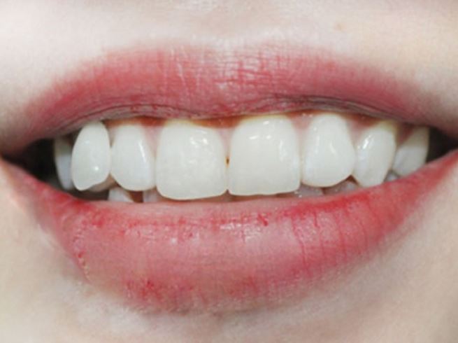 ‘Cái răng cái tóc là góc con người’: Hình dáng răng cửa tiết lộ bản chất bên trong