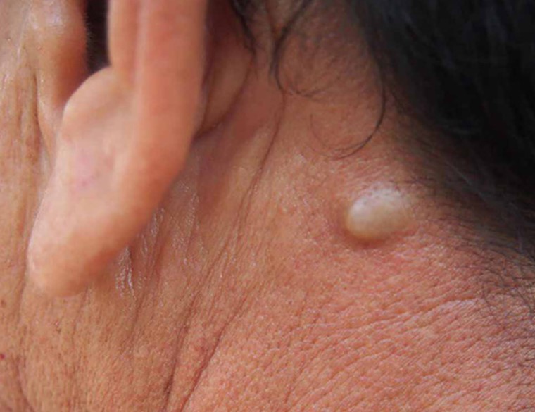 3 tín hiệu ở cổ là dấu hiệu sớm của bệnh ung thư tuyến giáp, kiểm tra xem bạn có gặp phải triệu chứng nào không