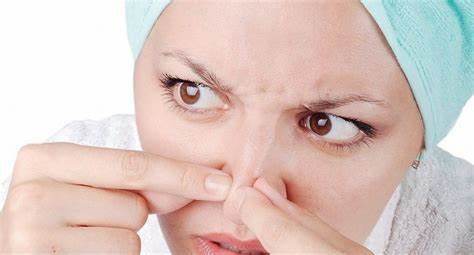 Mụn cám vùng cánh mũi hết sạch nhờ tuân thủ bộ bí kíp sau