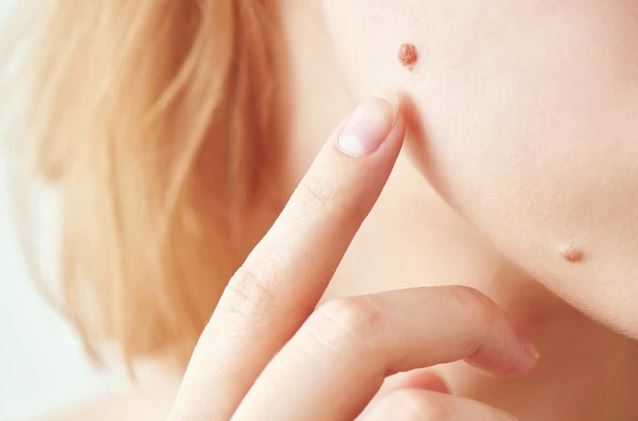 5 dấu hiệu trên nốt ruồi cảnh báo ung thư