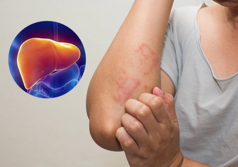 Có một trong những dấu hiệu này, có thể bệnh gan đã đi vào giai đoạn nặng trên cơ thể bạn