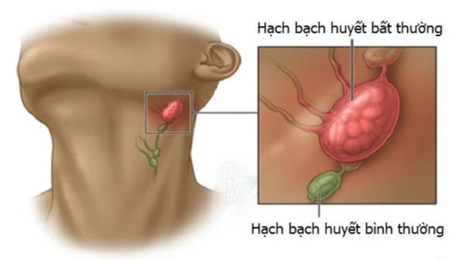 Hạch dấu hiệu của ung thư khác lành tính như thế nào?