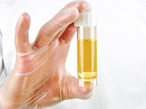 Bí quyết nhìn nước tiểu đoán bệnh trong cơ thể